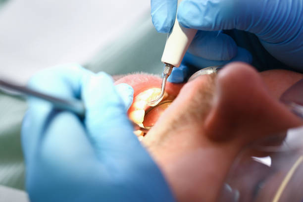 Best Emergency Dentist for Lost Fillings or Crowns in Salida, CA